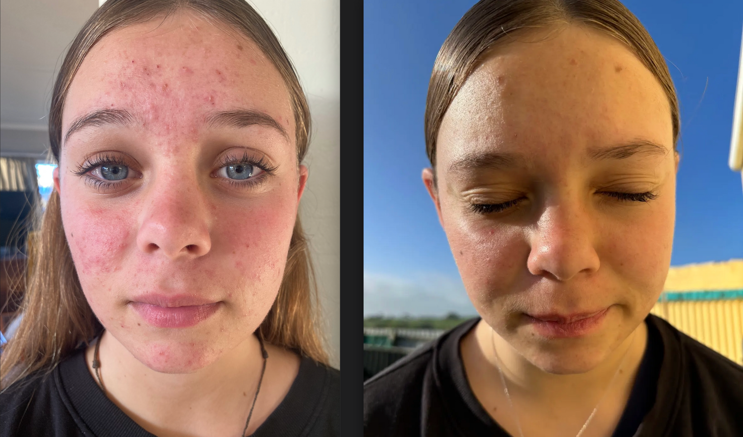 Acne and Skincare – Simple is Best!